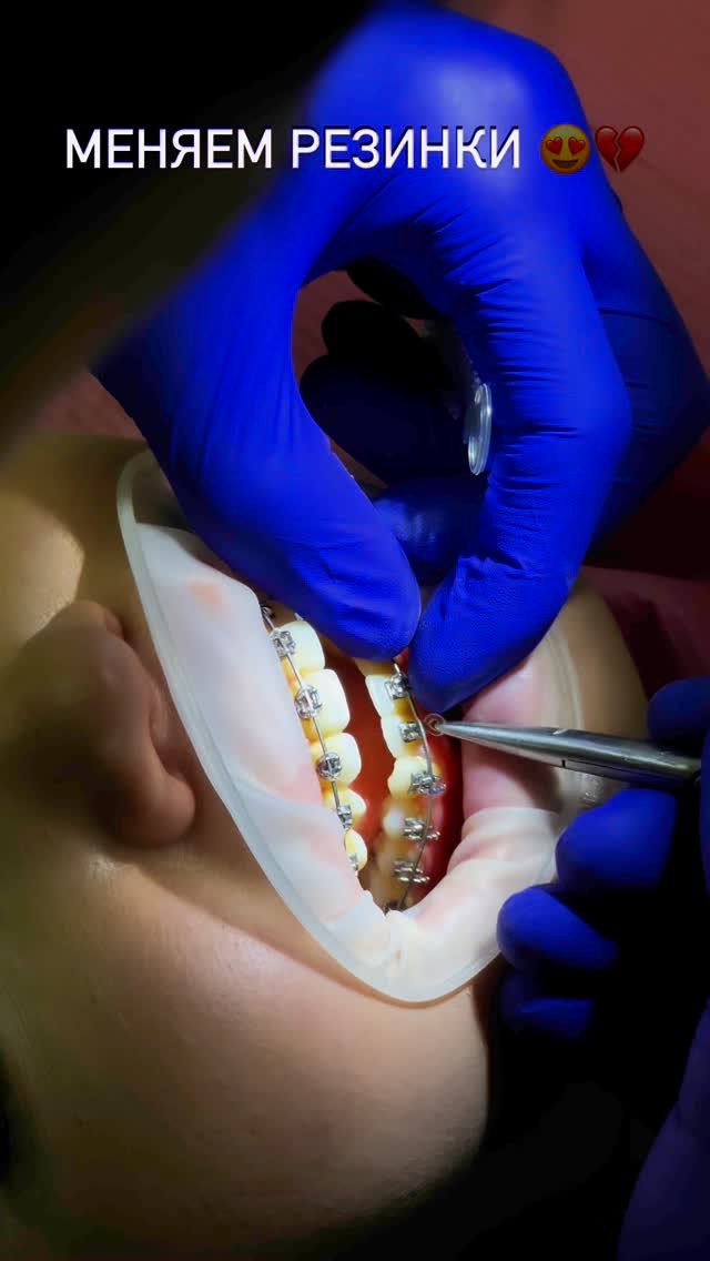 Замена резинок на брекетах